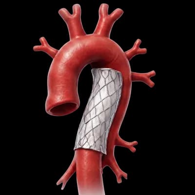 Aortic Aneurysm & Aortic Surgery in Mumbai: A Surgeon's Guide